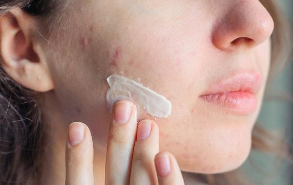 برای درمان جوش صورت در پوست های خشک چه باید کرد؟